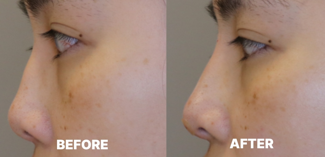Nose Filler: Before & After